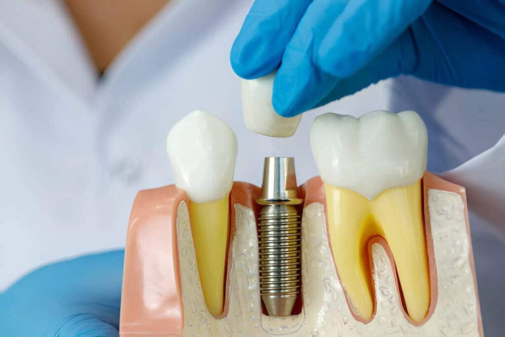 What Not to do Before at Dental Implant?